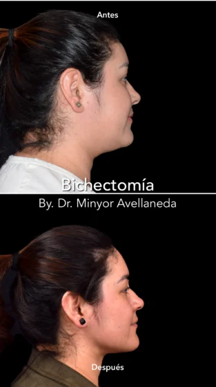 Bichectomía by Dr Minyor Avellaneda