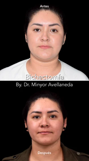 Bichectomía by Dr Minyor Avellaneda