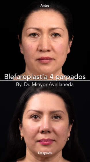 Blefaroplastia By Minyor Avellaneda