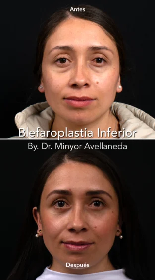Blefaroplastia By Minyor Avellaneda