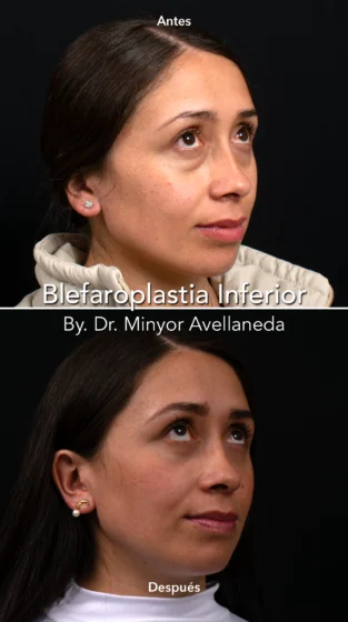 Blefaroplastia By Minyor Avellaneda
