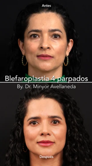 Blefaroplastia By Minyor Avellaneda