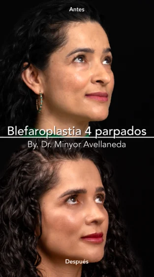 Blefaroplastia By Minyor Avellaneda