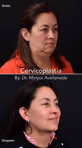 Cervicoplastia By. Dr Minyor Avellaneda