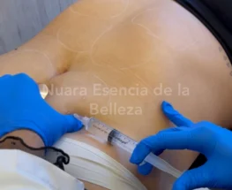 Fibrosis con Enzimas
