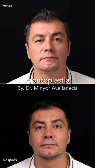 Frontoplastia By Dr Minyor Avellaneda