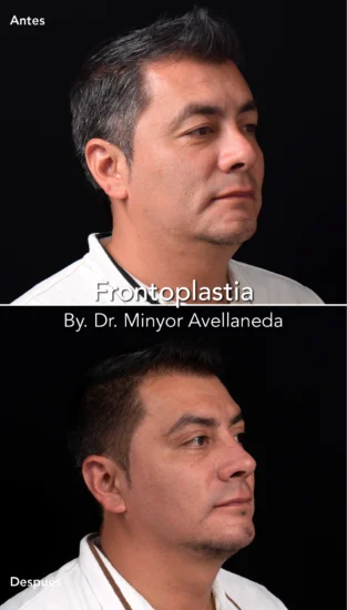 Frontoplastia By Dr Minyor Avellaneda
