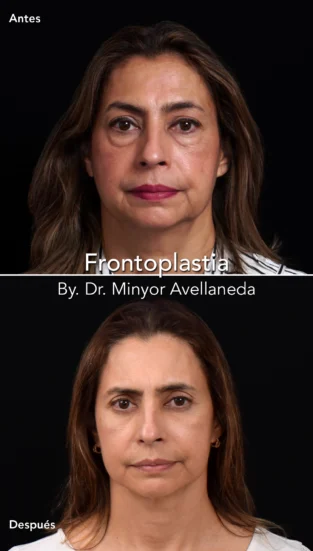 Frontoplastia By Dr Minyor Avellaneda
