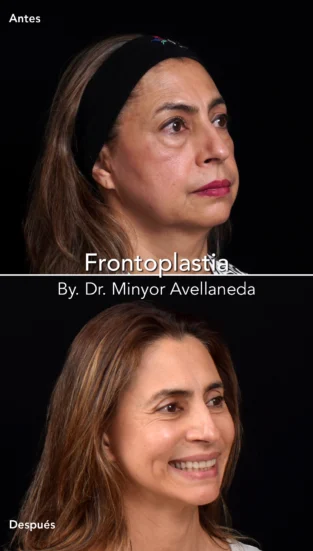 Frontoplastia By Dr Minyor Avellaneda