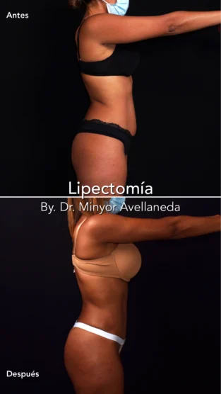 Lipectomia By Dr. Minyor Avellaneda