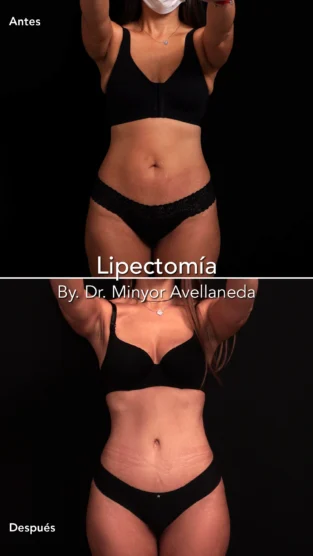 Lipectomia By Dr. Minyor Avellaneda