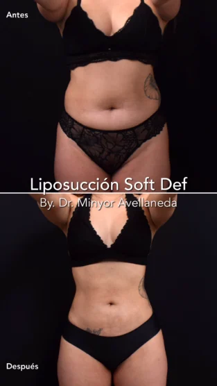 Liposuccion By Dr. Minyor Avellaneda
