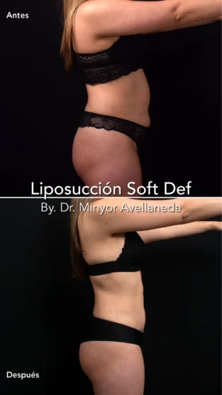 Liposuccion By Dr. Minyor Avellaneda