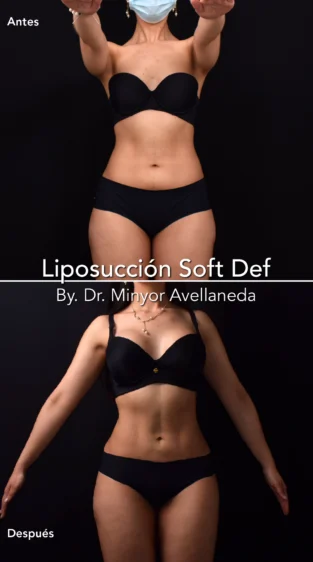 Liposuccion By Dr. Minyor Avellaneda