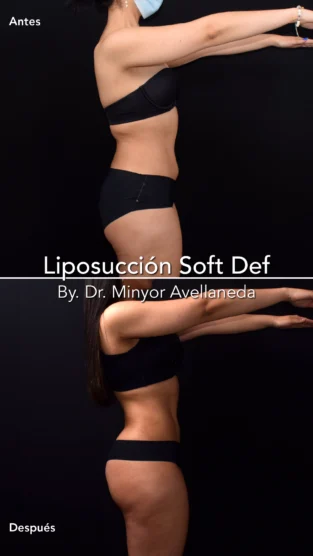 Liposuccion By Dr. Minyor Avellaneda