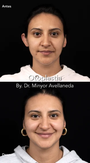 Otoplastia By Dr. Minyor Avellaneda