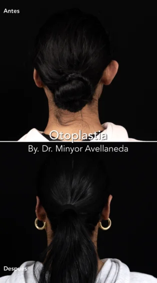 Otoplastia By Dr. Minyor Avellaneda