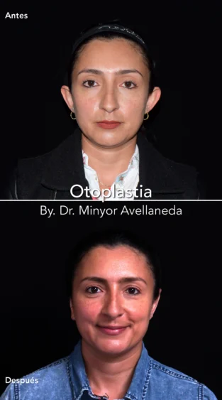 Otoplastia By Dr. Minyor Avellaneda