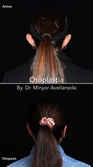 Otoplastia By Dr. Minyor Avellaneda