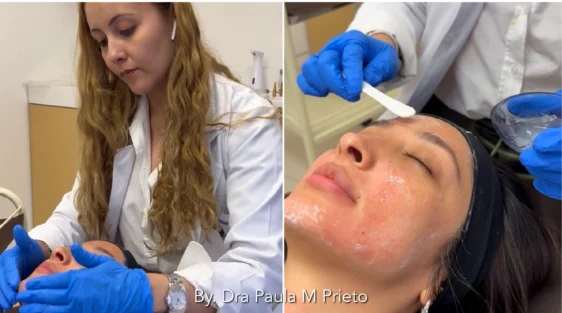 Peeling Acné por Dra Paula M Prieto