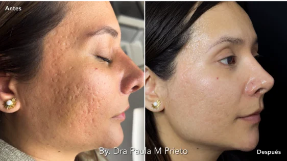 Peeling Acné por Dra Paula M Prieto