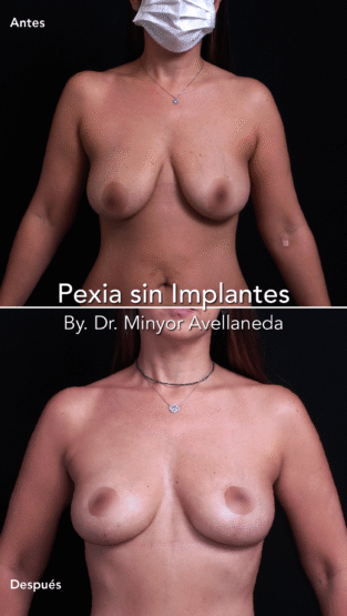 Pexia Mamaria sin Implantes By Dr Minyor Avellaneda