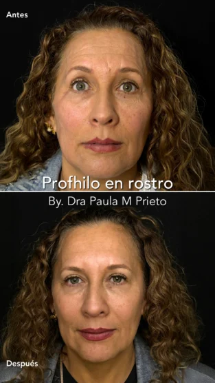 Profhilo por Dra Paula M Prieto