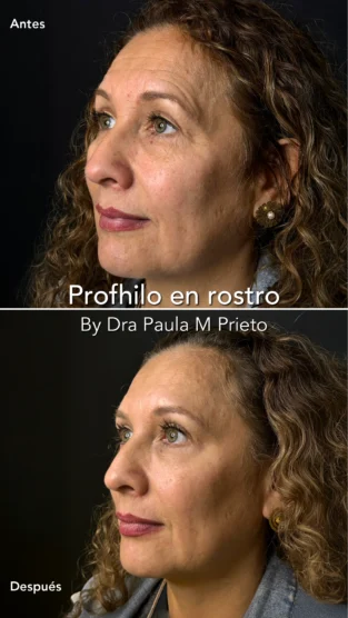 Profhilo por Dra Paula M Prieto
