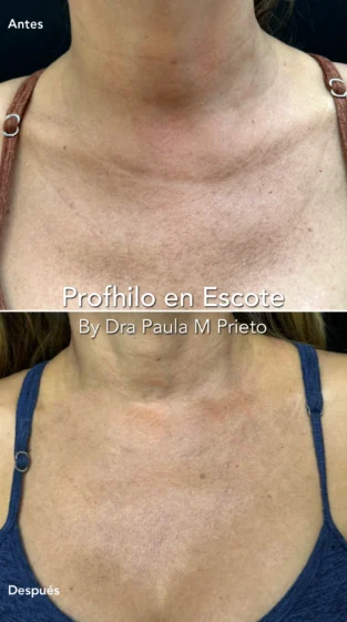 Profhilo por Dra Paula M Prieto