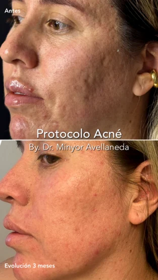 Protocolo Acne por Dra Paula M Prieto