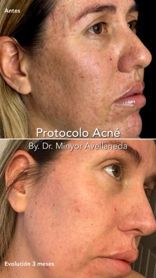 Protocolo Acne por Dra Paula M Prieto