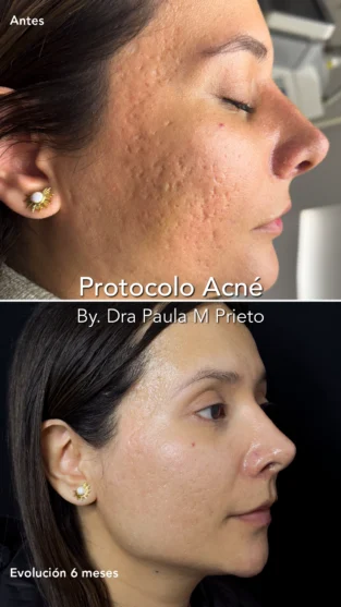 Protocolo Acne por Dra Paula M Prieto