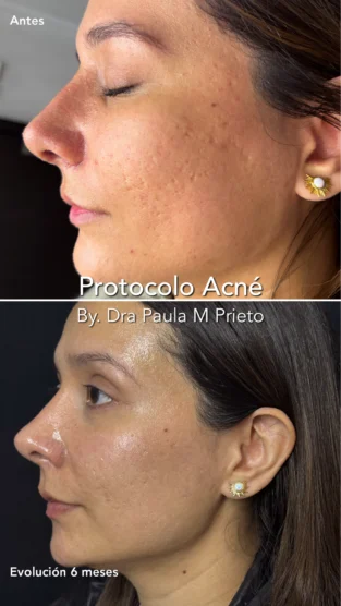 Protocolo Acne por Dra Paula M Prieto