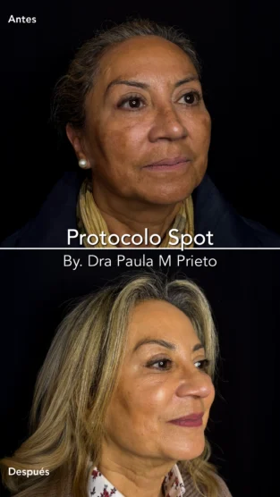 Protocolo Spot por Dra Paula M Prieto