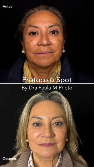 Protocolo Spot por Dra Paula M Prieto