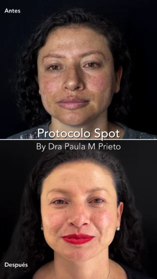 Protocolo Spot por Dra Paula M Prieto