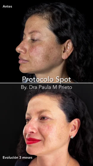 Protocolo Spot por Dra Paula M Prieto