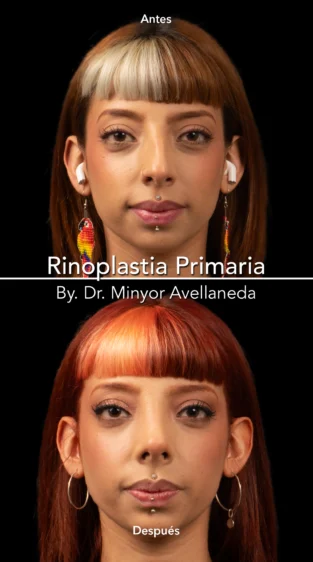Rinoplastia Ultrasonica By Minyor Avellaneda