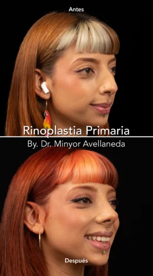 Rinoplastia Ultrasonica By Minyor Avellaneda