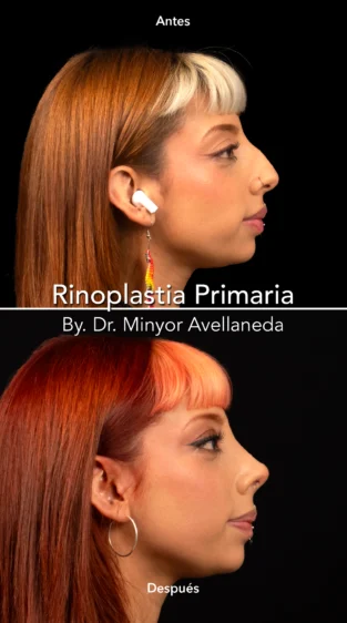 Rinoplastia Ultrasonica By Minyor Avellaneda