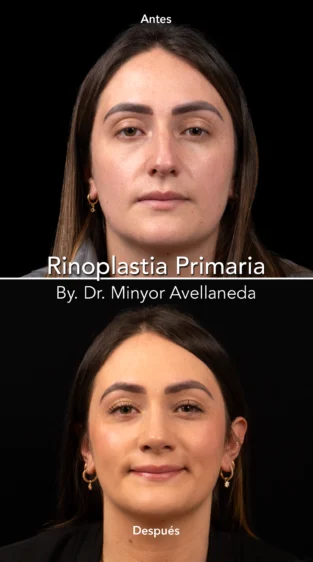 Rinoplastia Ultrasonica By Minyor Avellaneda