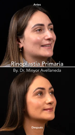 Rinoplastia Ultrasonica By Minyor Avellaneda