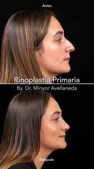 Rinoplastia Ultrasonica By Minyor Avellaneda
