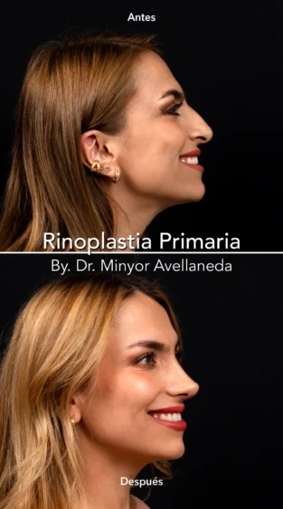 Rinoplastia Ultrasonica By Minyor Avellaneda