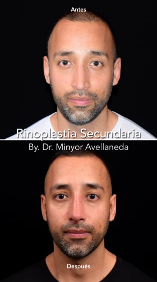 Rinoplastia Ultrasonica By Minyor Avellaneda