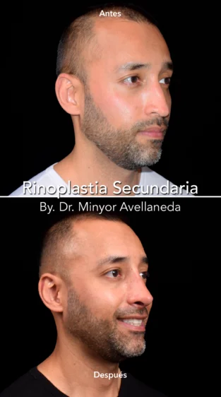 Rinoplastia Ultrasonica By Minyor Avellaneda