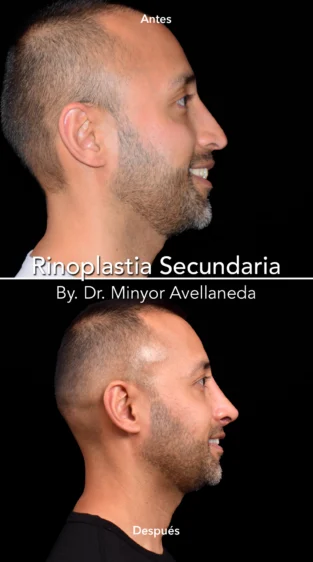 Rinoplastia Ultrasonica By Minyor Avellaneda