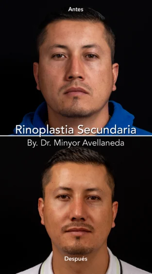 Rinoplastia Ultrasonica By Minyor Avellaneda
