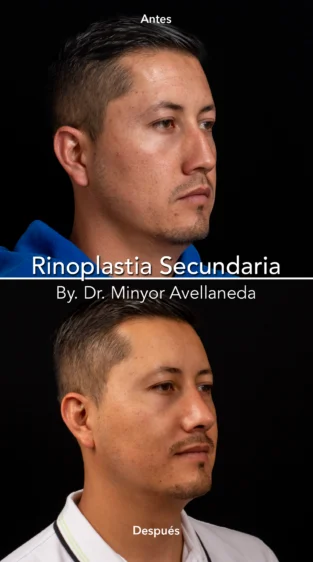 Rinoplastia Ultrasonica By Minyor Avellaneda