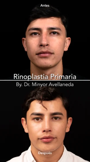 Rinoplastia Ultrasonica By Minyor Avellaneda